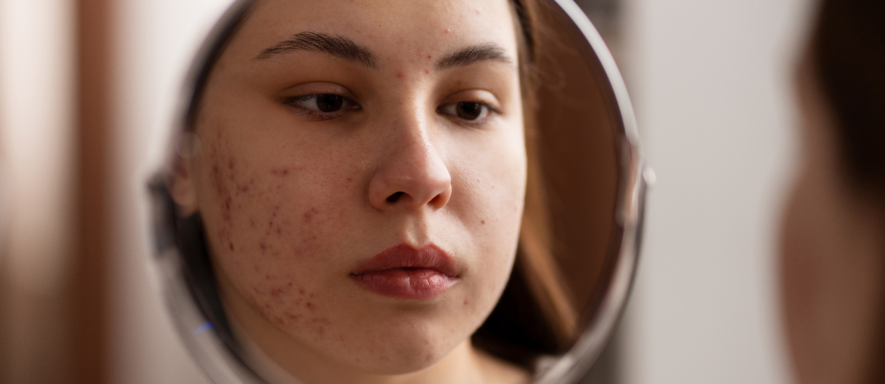 Post-Inflammatory Hyperpigmentation: A Comprehensive Guide to Restoring Radiance