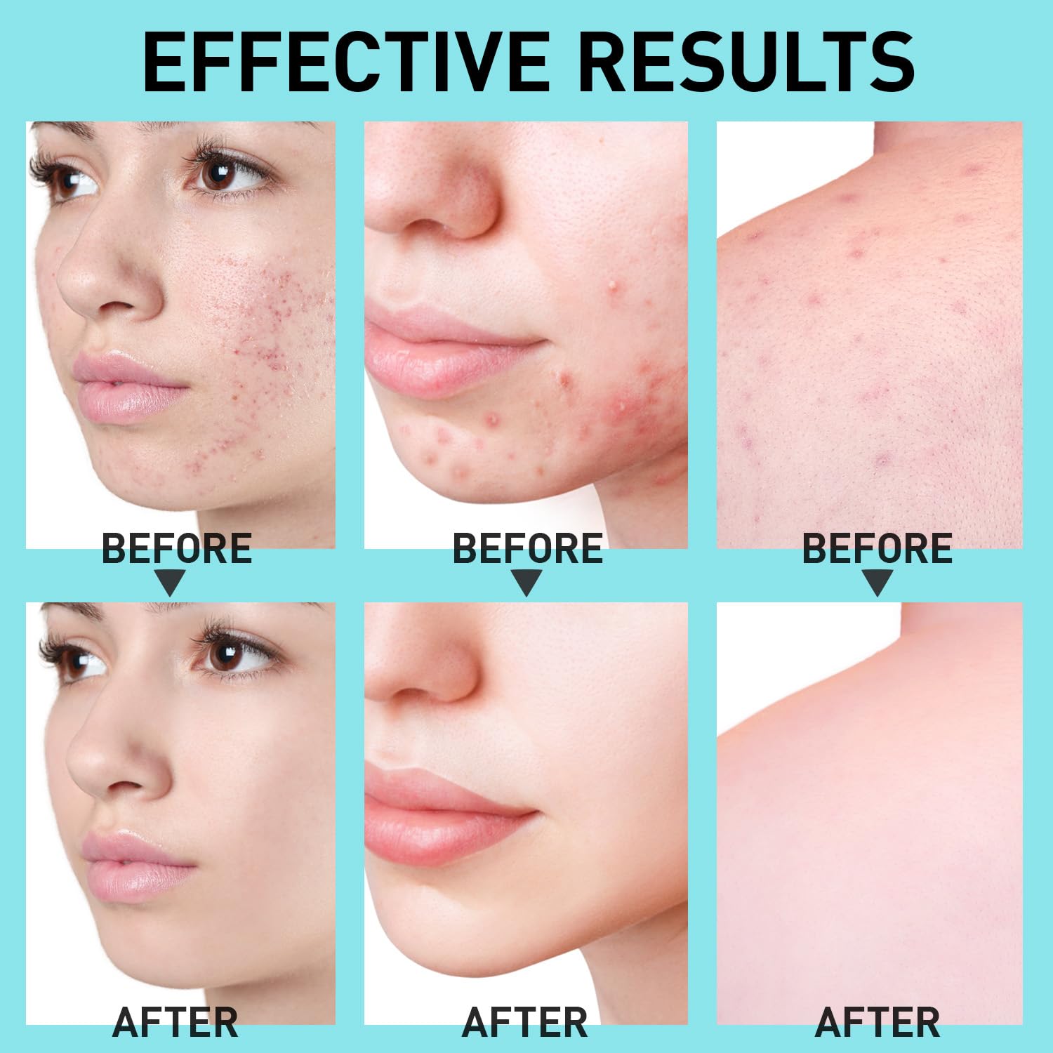 10% Azelaic Acid Acne Treatment